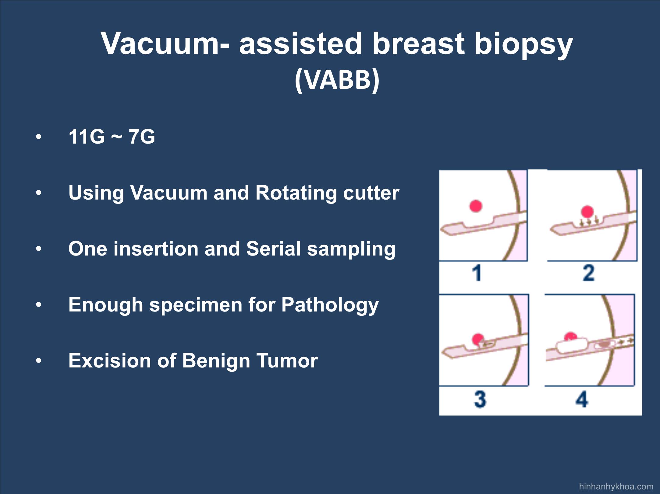 Evaluation of the initial efficacy in the removal of benign breast lesions by vacuum - Assisted biopsy in radiology center of Bach Mai hospital trang 5