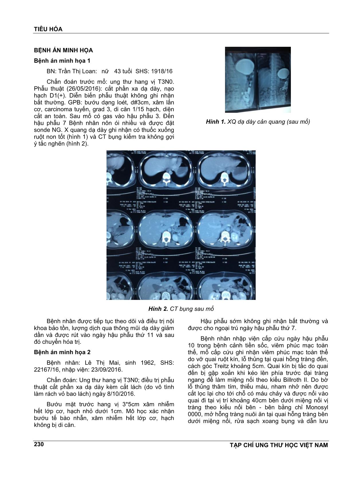 Biến chứng sớm sau phẫu thuật cắt phần xa dạ dày nối billroth II trang 2