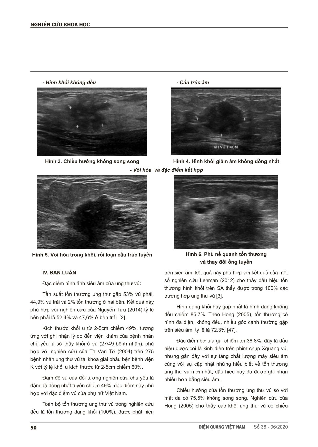 Đặc điểm hình ảnh siêu âm của ung thư tuyến vú tại bệnh viện Bạch Mai trang 4