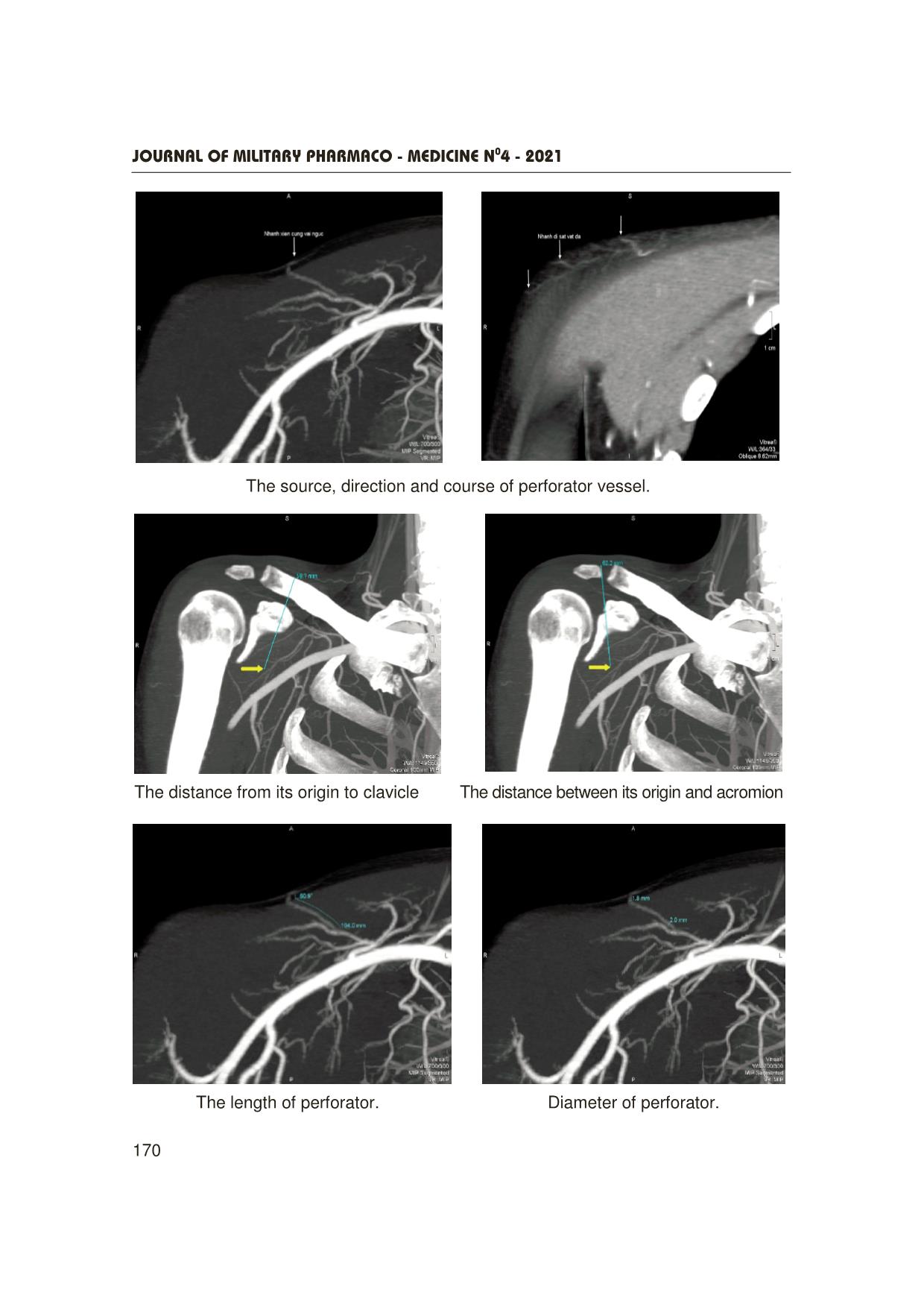 Multidetector-Row computed tomography analysis of the anatomical characteristics of thoracoacromial artery perforator trang 9
