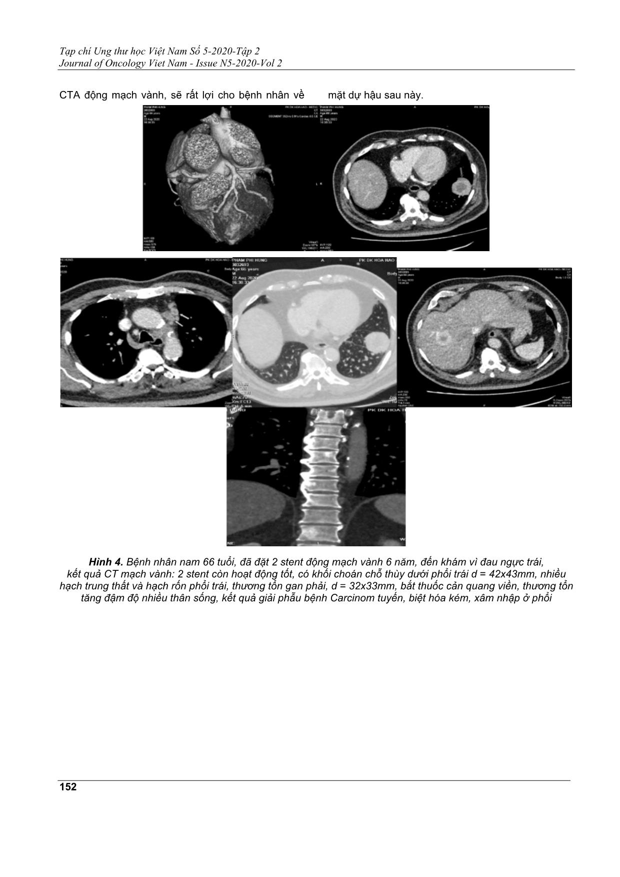 Phát hiện tình cờ sang thương ung bướu khi chụp cắt lớp vi tính động mạch vành có cản quang trang 5