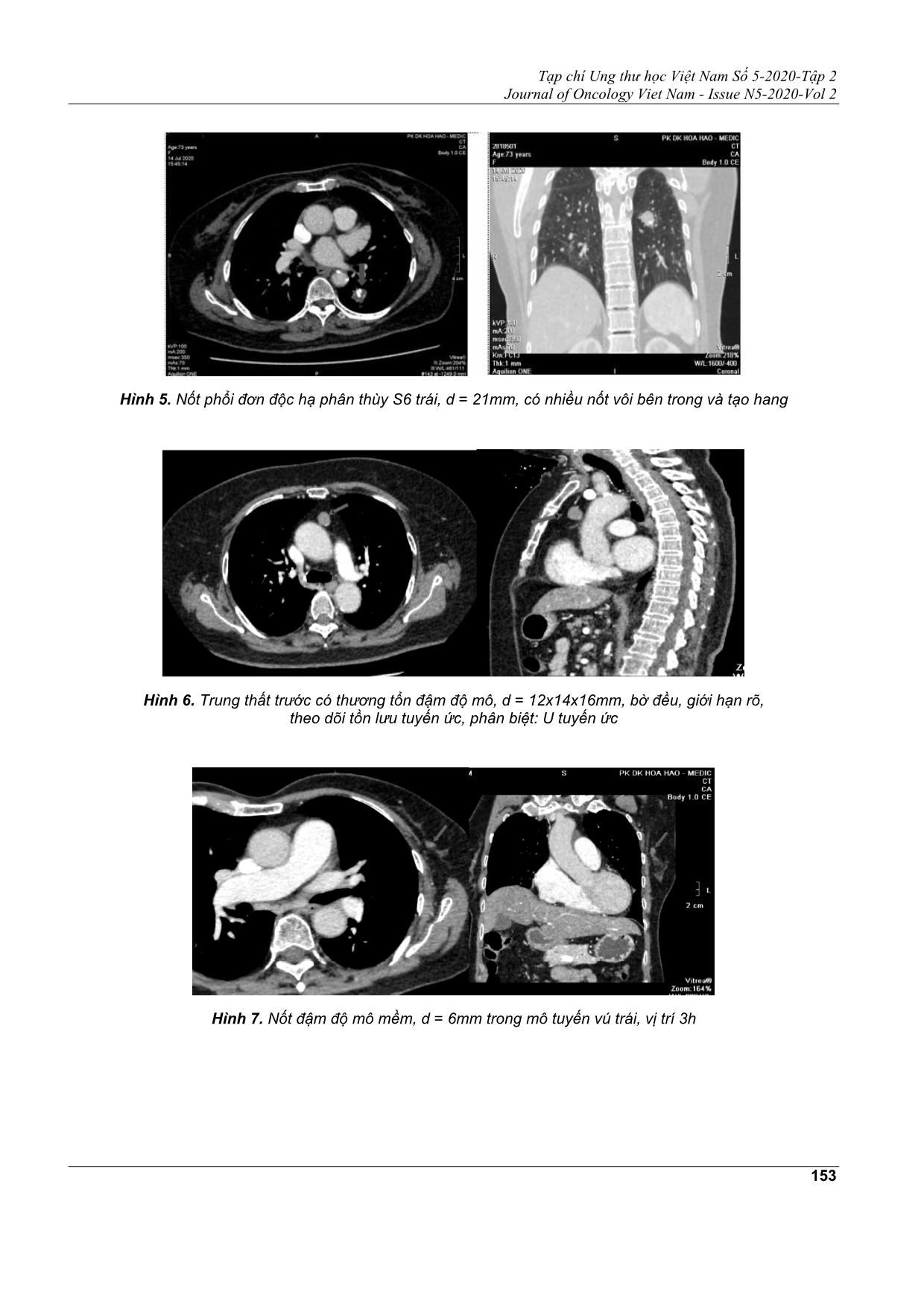 Phát hiện tình cờ sang thương ung bướu khi chụp cắt lớp vi tính động mạch vành có cản quang trang 6