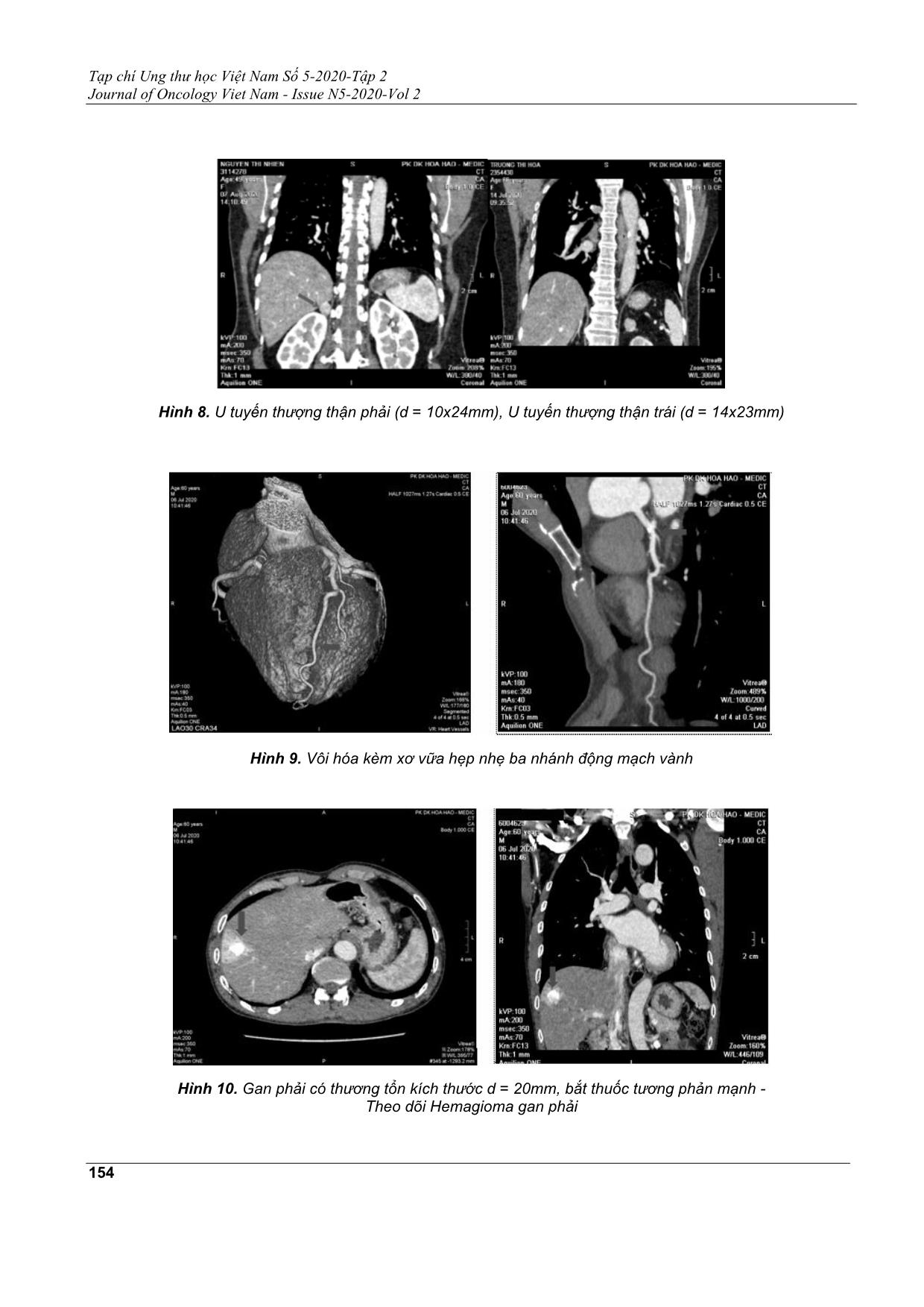 Phát hiện tình cờ sang thương ung bướu khi chụp cắt lớp vi tính động mạch vành có cản quang trang 7