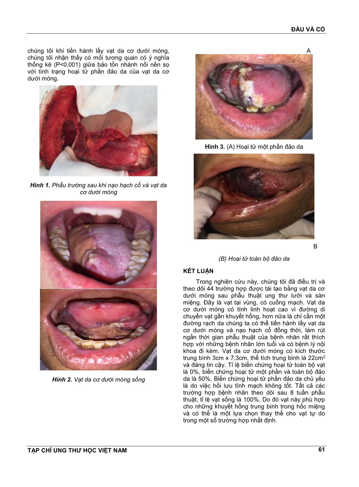 Sử dụng vạt da cơ dưới móng trong tạo hình ung thư lưỡi và sàn miệng trang 4