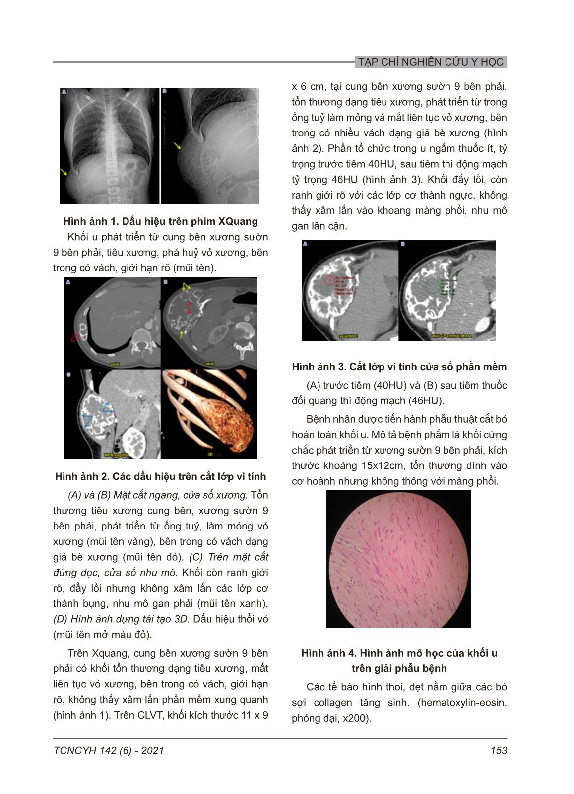 U xơ thể xơ cứng tại xương sườn: Báo cáo ca lâm sàng và y văn trang 2