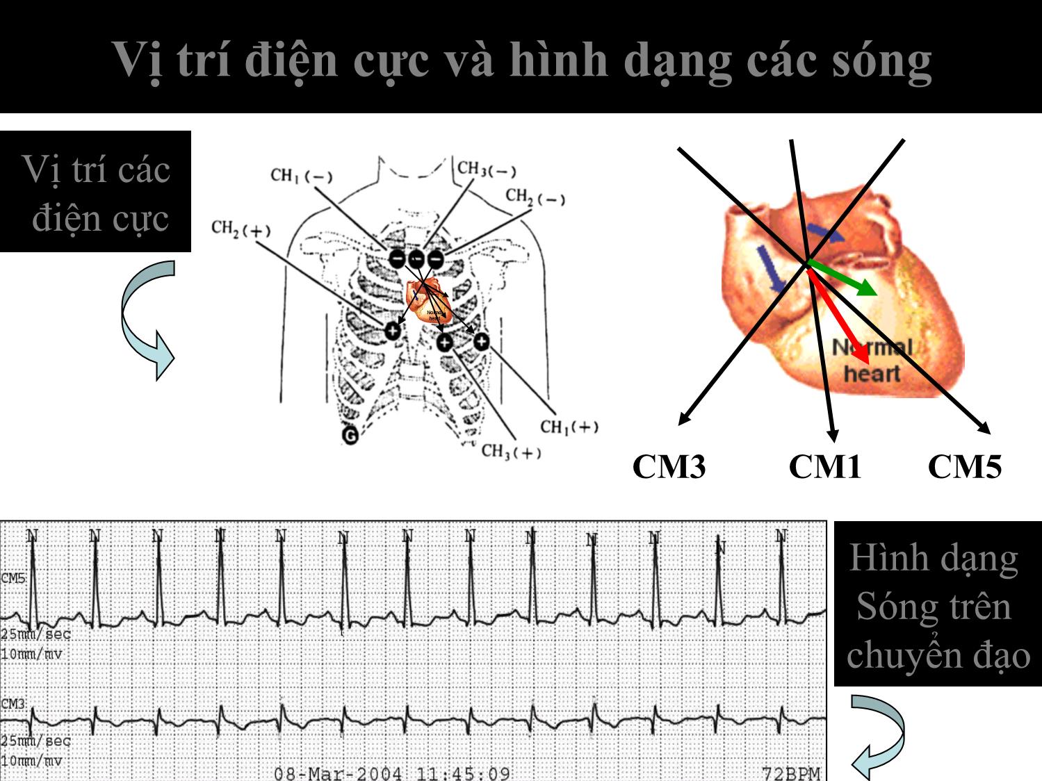 Rối loạn nhịp tim và biến thiên nhịp tim / holter điện tim 24 giờ ở bệnh nhân đái tháo đường týp 2 có biến chứng thận trang 10