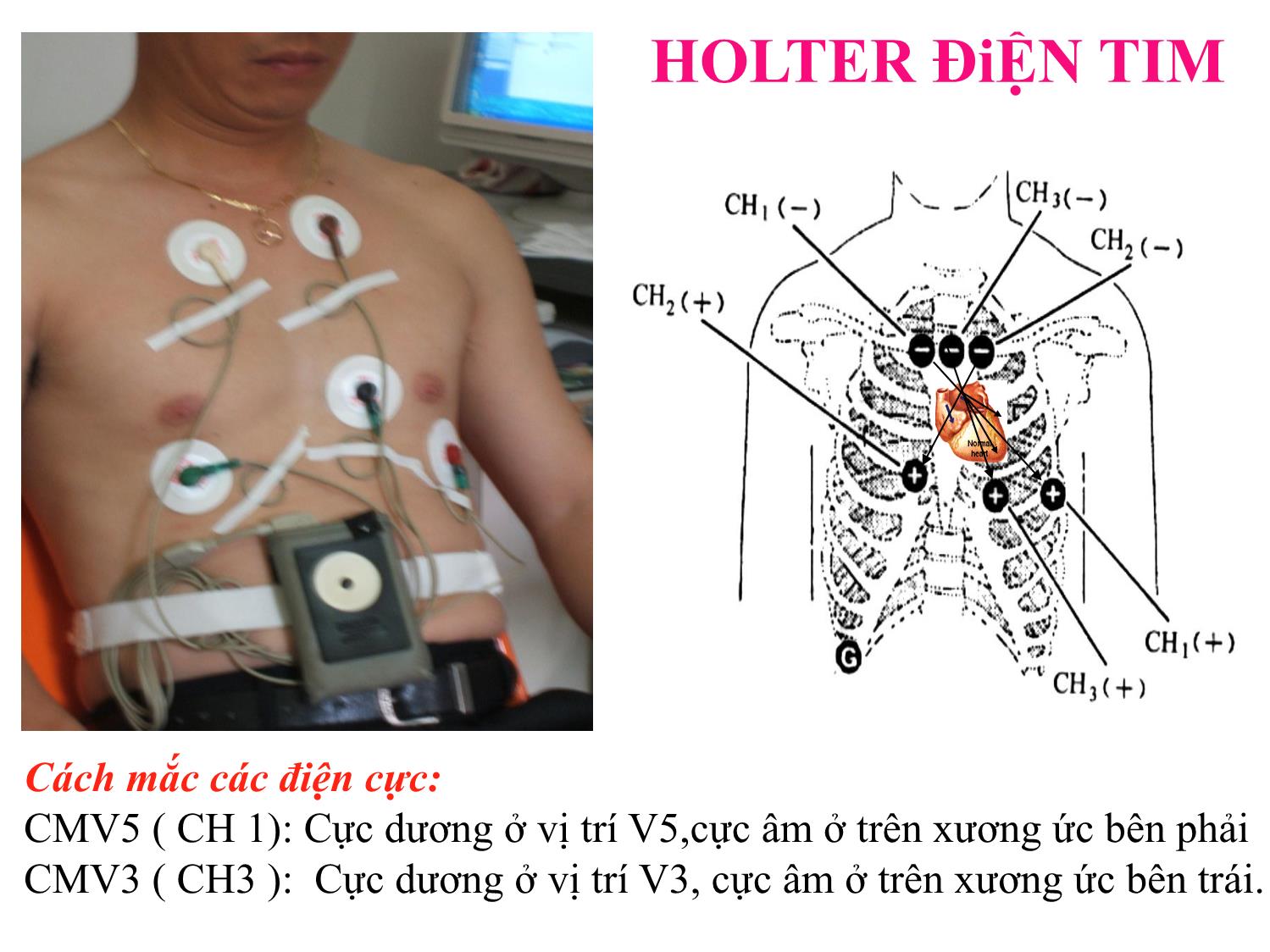 Rối loạn nhịp tim và biến thiên nhịp tim / holter điện tim 24 giờ ở bệnh nhân đái tháo đường týp 2 có biến chứng thận trang 9