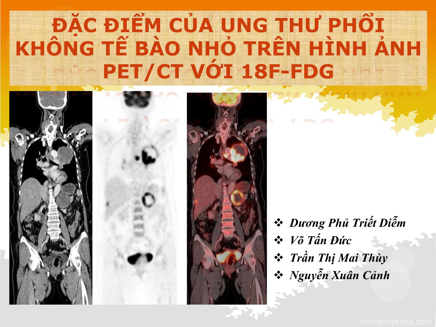 Đặc điểm của ung thư phối không tế bào nhỏ trên hình ảnh PET / CT với 18F - FDG trang 1