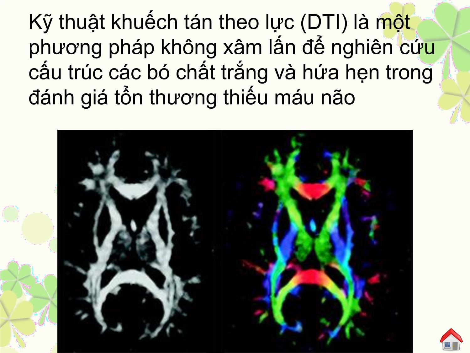 Đặc điểm hình ảnh bó tháp trên cộng hưởng từ khuếch tán theo hướng (dti) của người bình thường và thay đổi trong tổn thương nhồi máu não cấp trang 6