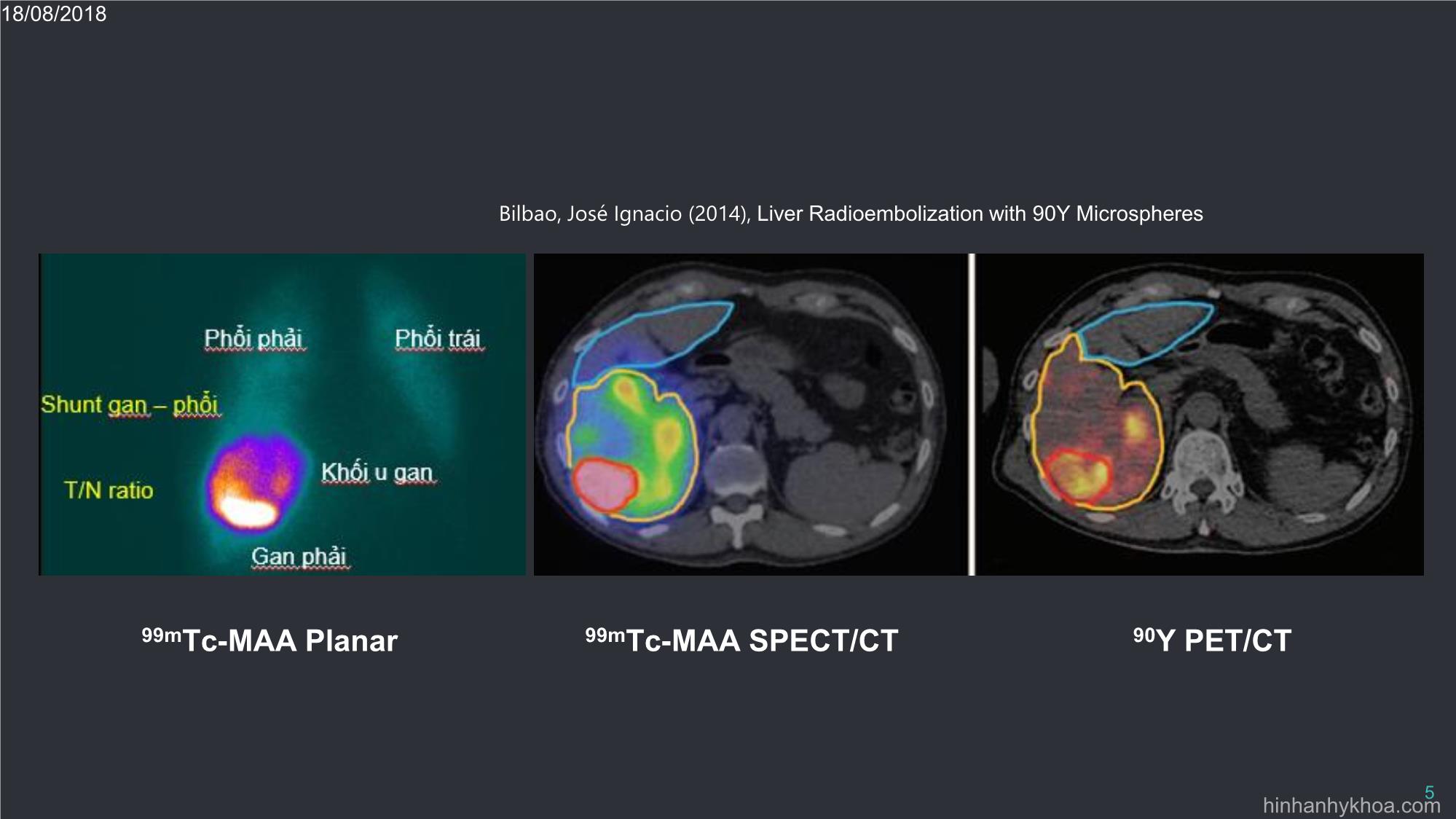 Đặc điểm xạ hình mô phỏng 99MTC - Maa planar và spect / ct đối chiếu xạ hình 90y pet / ct sau điều trị tắc mạch xạ trị ung thư biểu mô tế bào gan trang 5