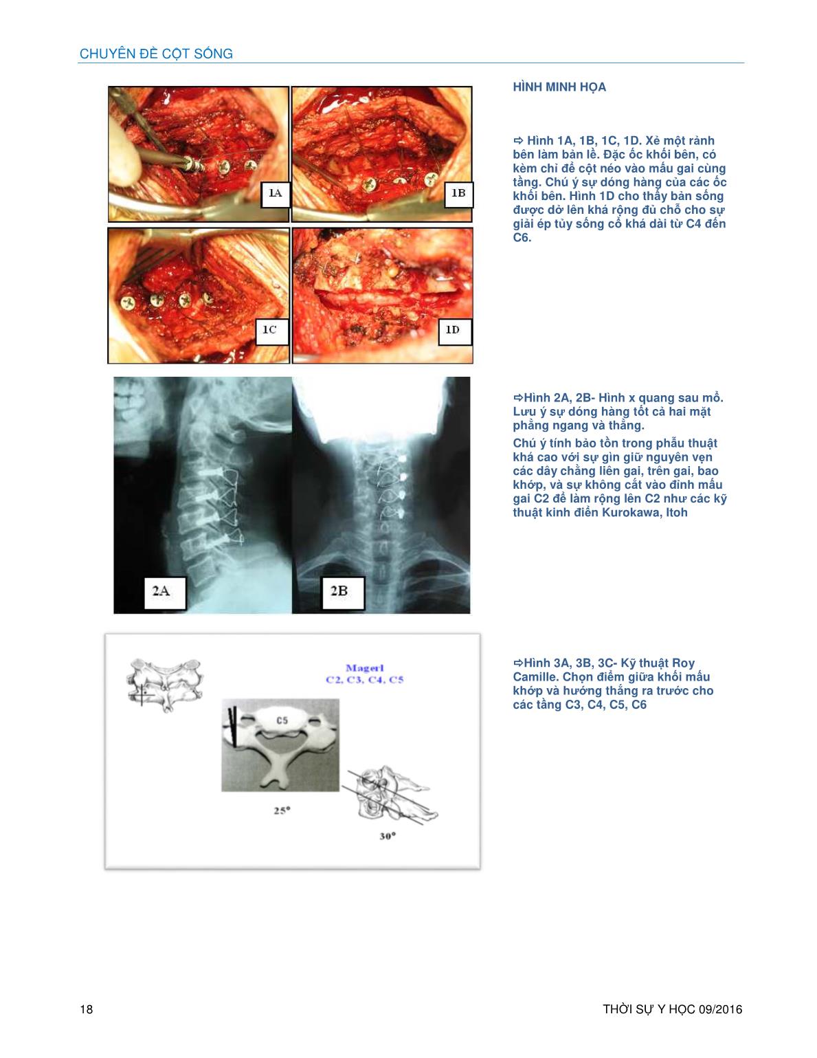 Phẫu thuật tạo hình bản sống mới - Hirabayashi cải biên - Néo ép đỉnh mấu gai vào ốc khối bên cho bệnh lý tủy sống cổ trang 6