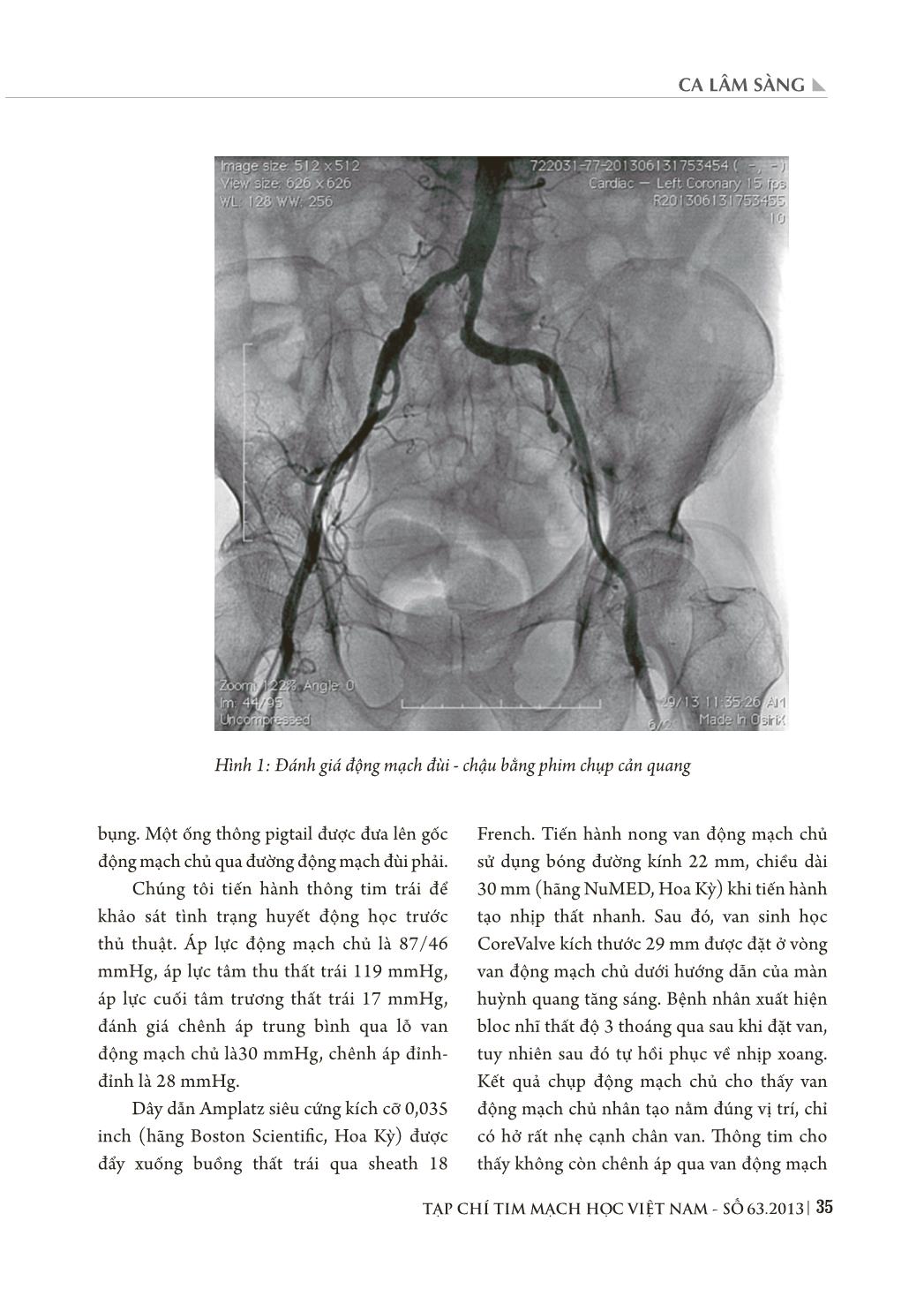 Ca lâm sàng thay van động mạch chủ sinh học loại CoreValve qua đường ống thông ở bệnh nhân hẹp khít van động mạch chủ có nguy cơ phẫu thuật cao trang 3