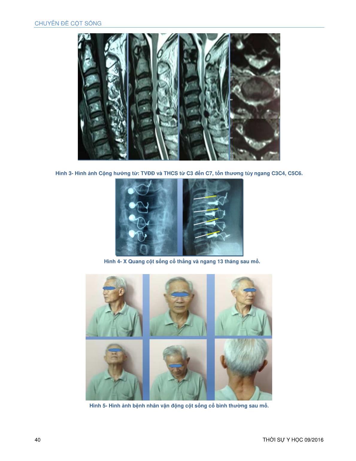 Phẫu thuật tạo hình bản sống VVT – kỹ thuật Hirabayashi cải biên – néo ép đỉnh mấu gai vào ốc khối bên cho bệnh lý tủy sống cổ trang 10