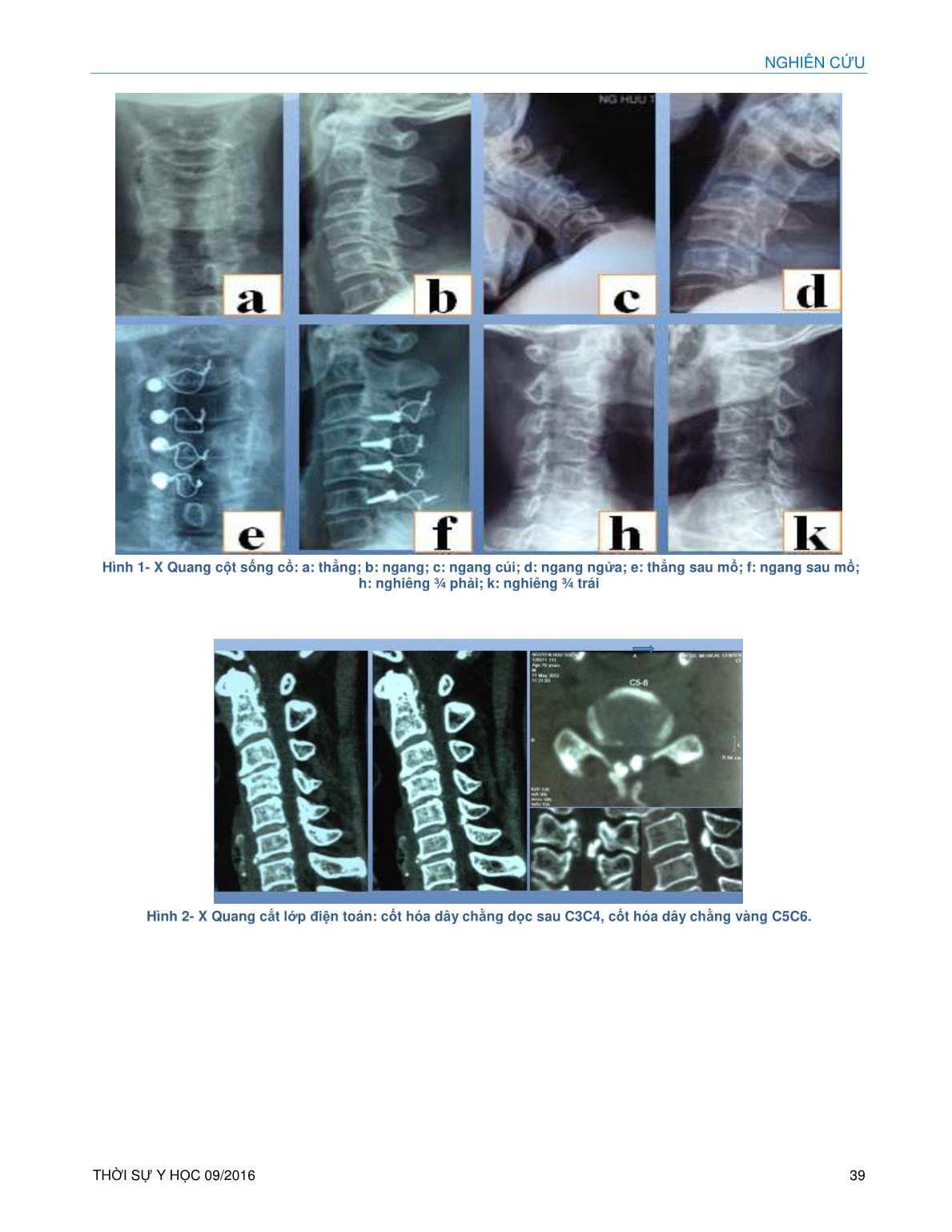 Phẫu thuật tạo hình bản sống VVT – kỹ thuật Hirabayashi cải biên – néo ép đỉnh mấu gai vào ốc khối bên cho bệnh lý tủy sống cổ trang 9