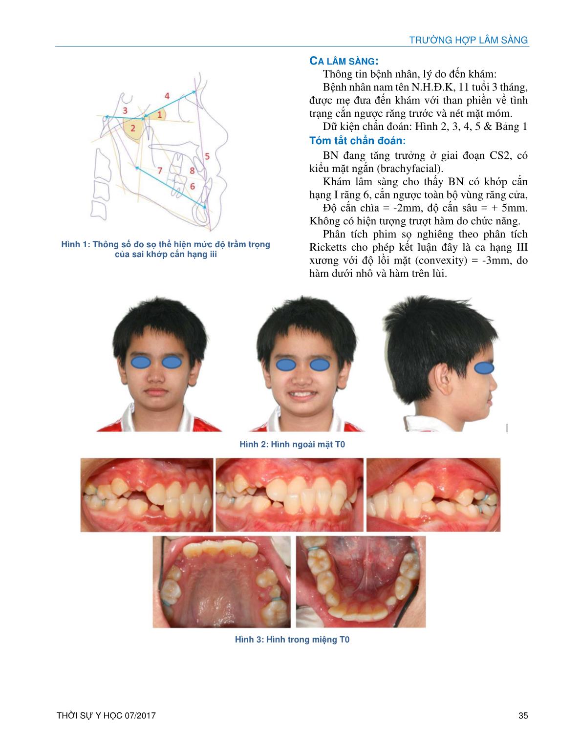 Điều trị hạng III xương sớm trên bệnh nhân mặt ngắn trang 2