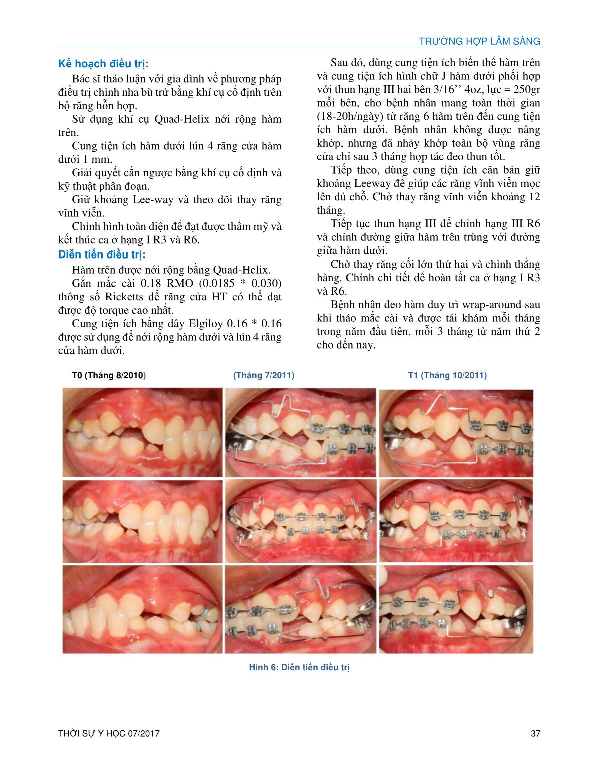 Điều trị hạng III xương sớm trên bệnh nhân mặt ngắn trang 4