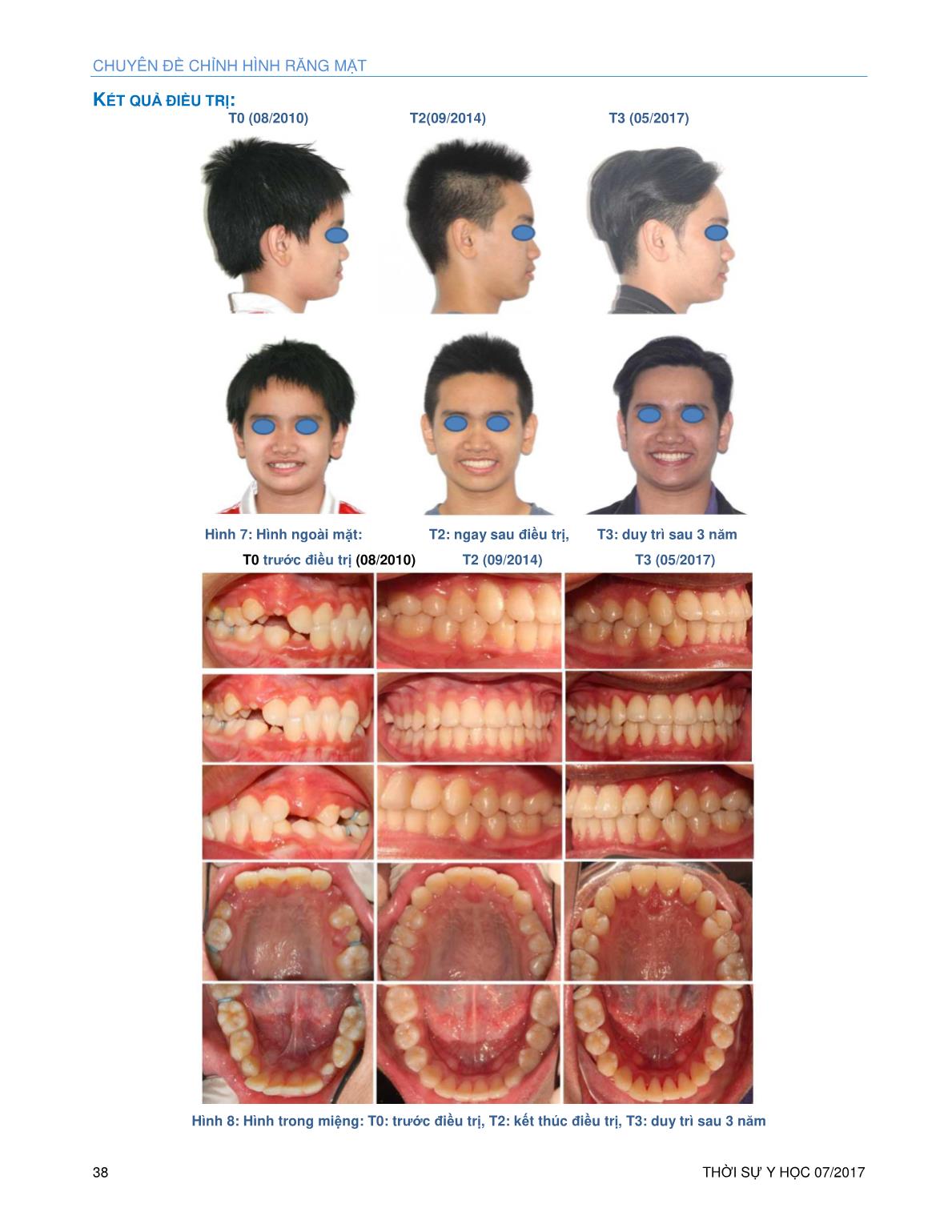 Điều trị hạng III xương sớm trên bệnh nhân mặt ngắn trang 5