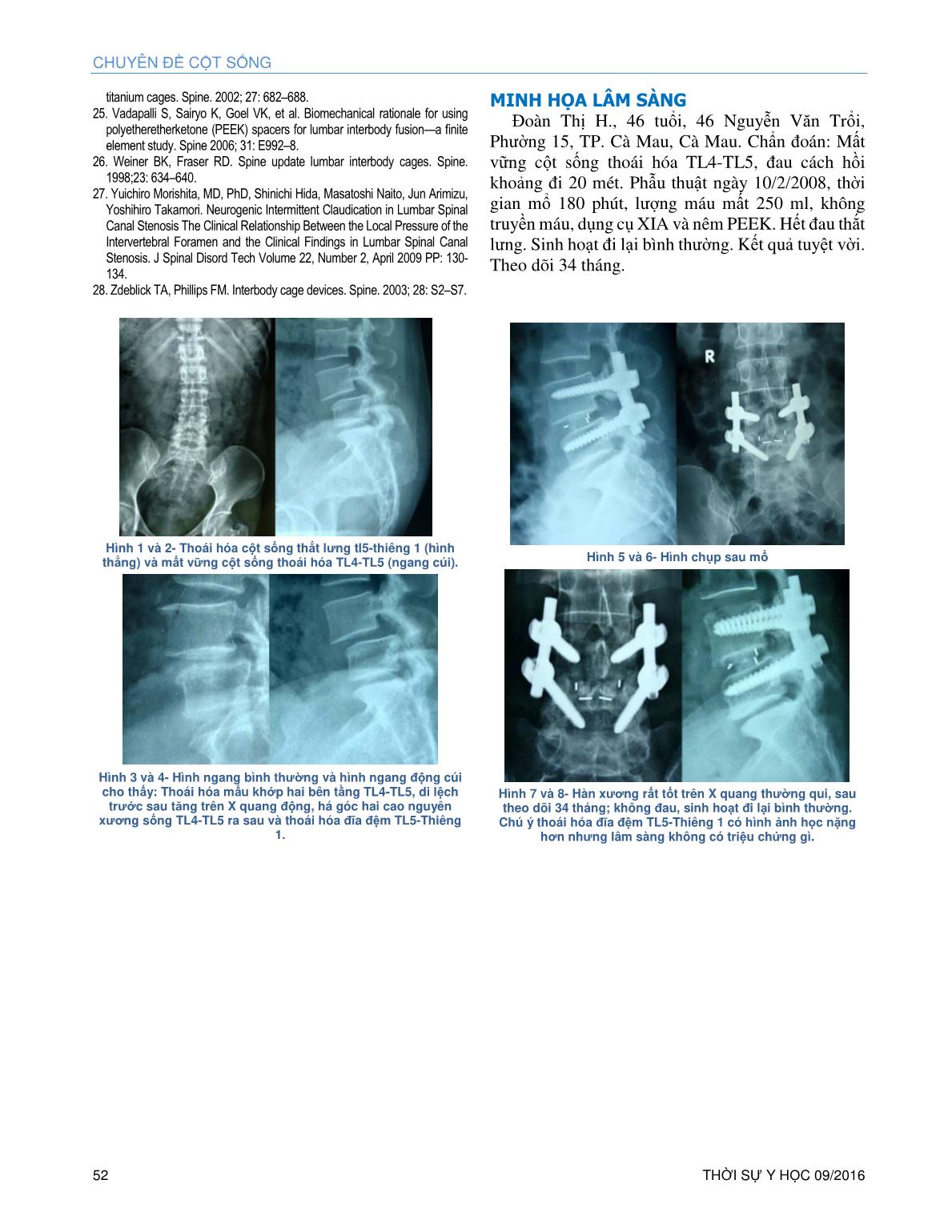Điều trị mất vững cột sống thắt lưng do trượt đốt sống thoái hóa bằng phẫu thuật cố định ốc chân cung và hàn liên thân đốt lối sau bằng nêm peek trang 7