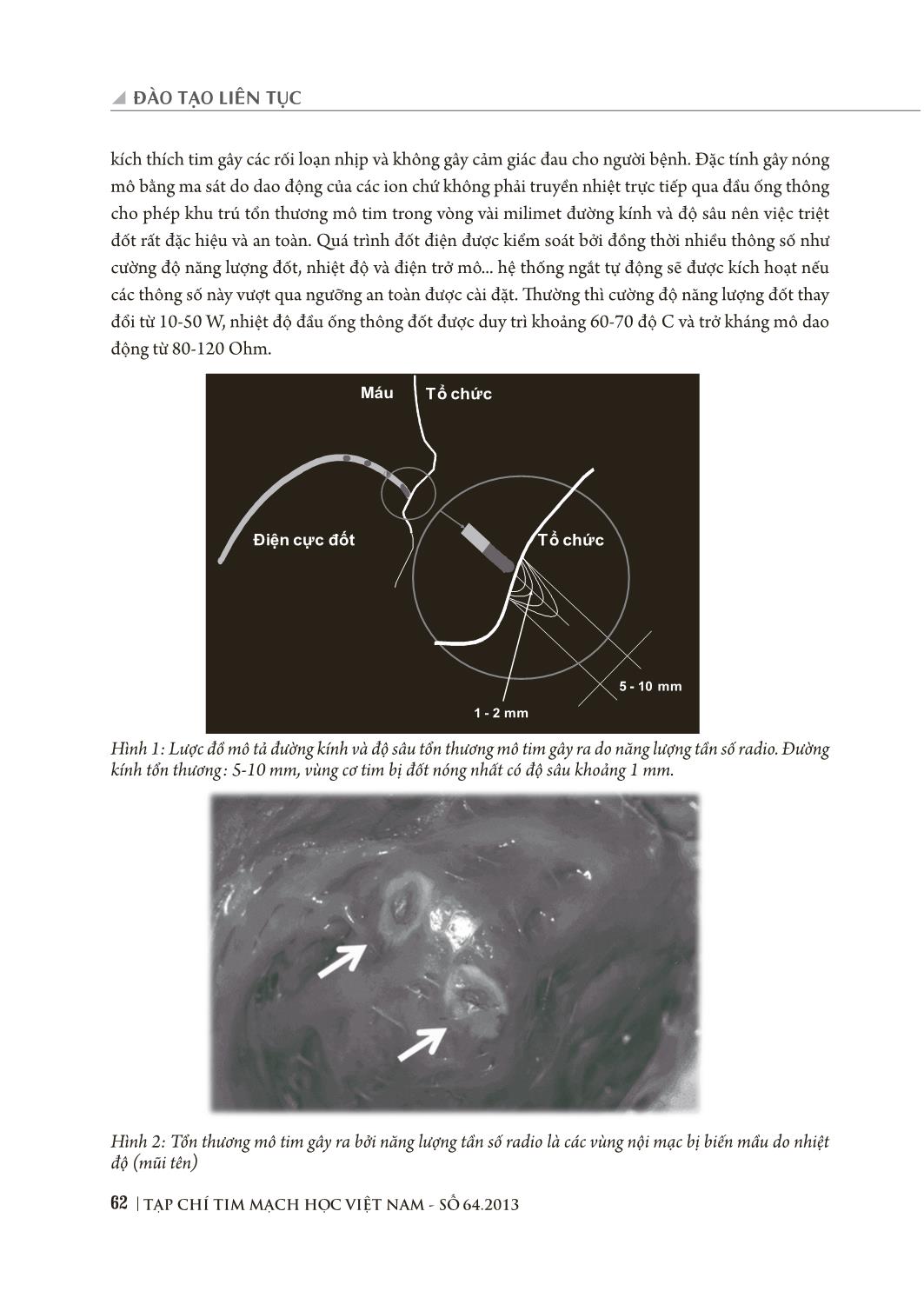Triệt đốt rối loạn nhịp tim bằng năng lượng sóng có tần số radio qua đường catheter trang 2