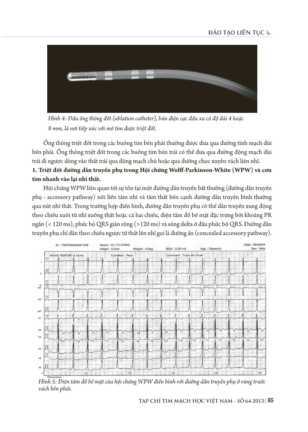 Triệt đốt rối loạn nhịp tim bằng năng lượng sóng có tần số radio qua đường catheter trang 5