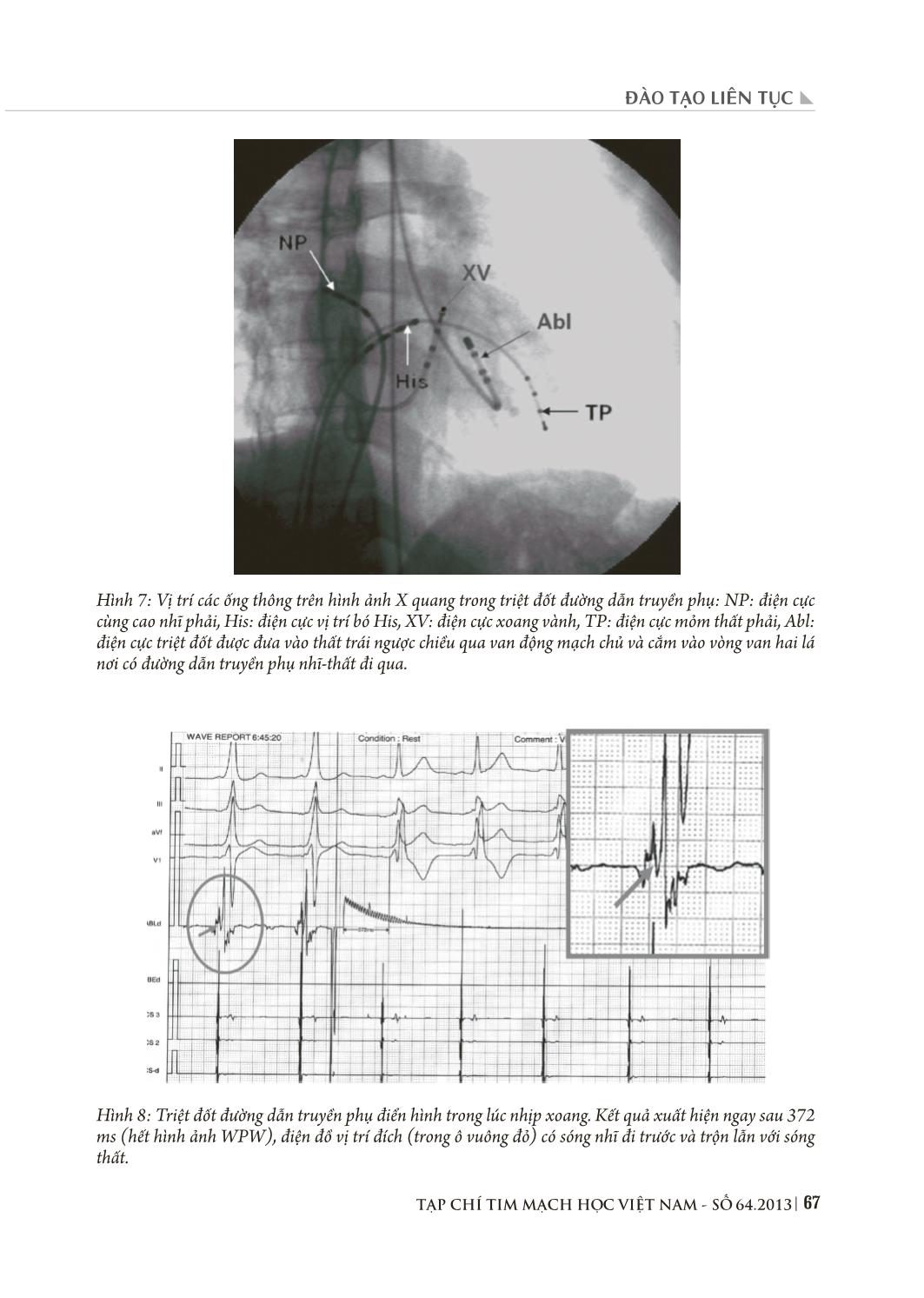 Triệt đốt rối loạn nhịp tim bằng năng lượng sóng có tần số radio qua đường catheter trang 7