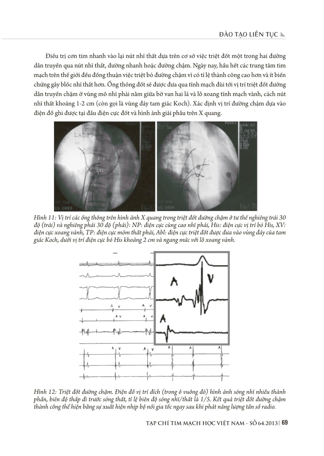 Triệt đốt rối loạn nhịp tim bằng năng lượng sóng có tần số radio qua đường catheter trang 9