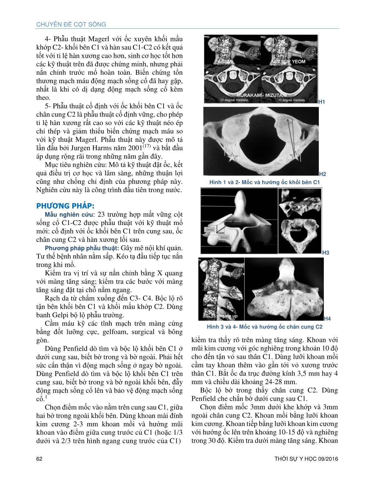 Điều trị gãy trật cột sống cổ C1-C2 do gãy chân mấu răng C2 bằng cấu hình ốc khối bên C1 và ốc chân cung C2- Hàn xương lối sau trang 2