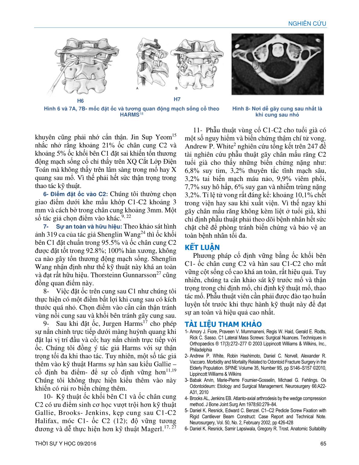 Điều trị gãy trật cột sống cổ C1-C2 do gãy chân mấu răng C2 bằng cấu hình ốc khối bên C1 và ốc chân cung C2- Hàn xương lối sau trang 5