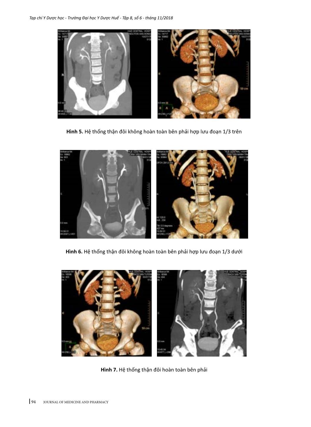 Hình ảnh cắt lớp vi tính 64 dãy của đường tiết niệu trên ở người cho thận sống trang 6