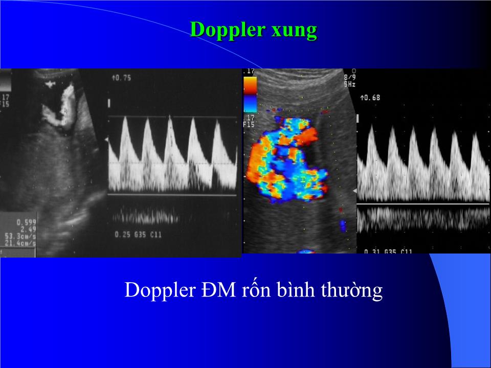 Bài giảng Siêu âm sản phụ khoa trang 8