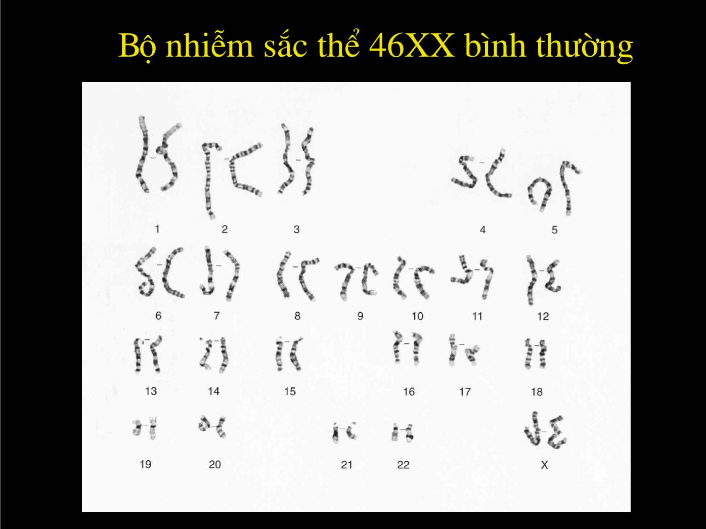 Bài giảng Siêu âm chẩn đoán bất thường về nhiễm sắc thể - Nguyễn Xuân Hiền trang 2