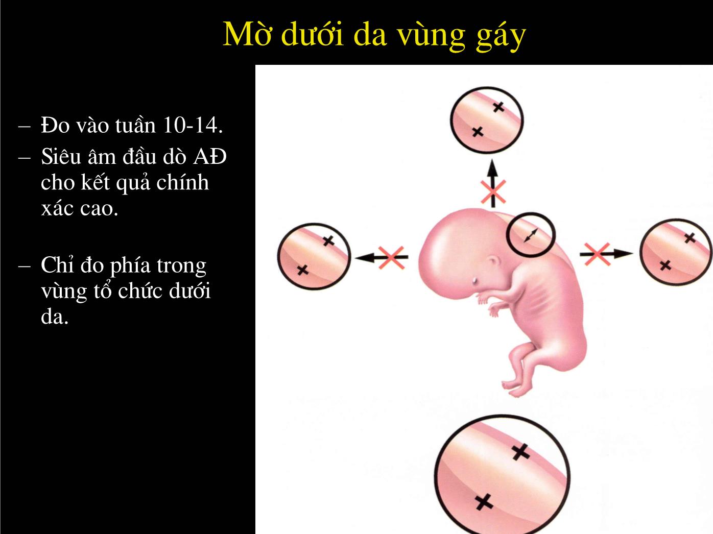 Bài giảng Siêu âm chẩn đoán bất thường về nhiễm sắc thể - Nguyễn Xuân Hiền trang 8