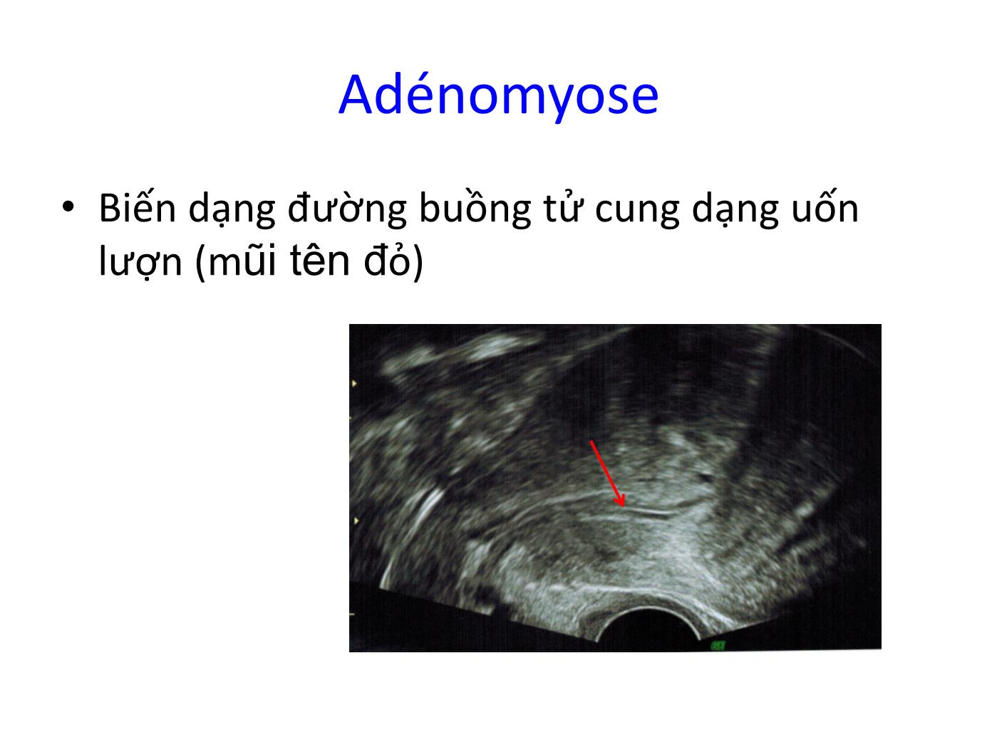 Bài giảng Bệnh lý cơ tử cung phần 2 trang 10