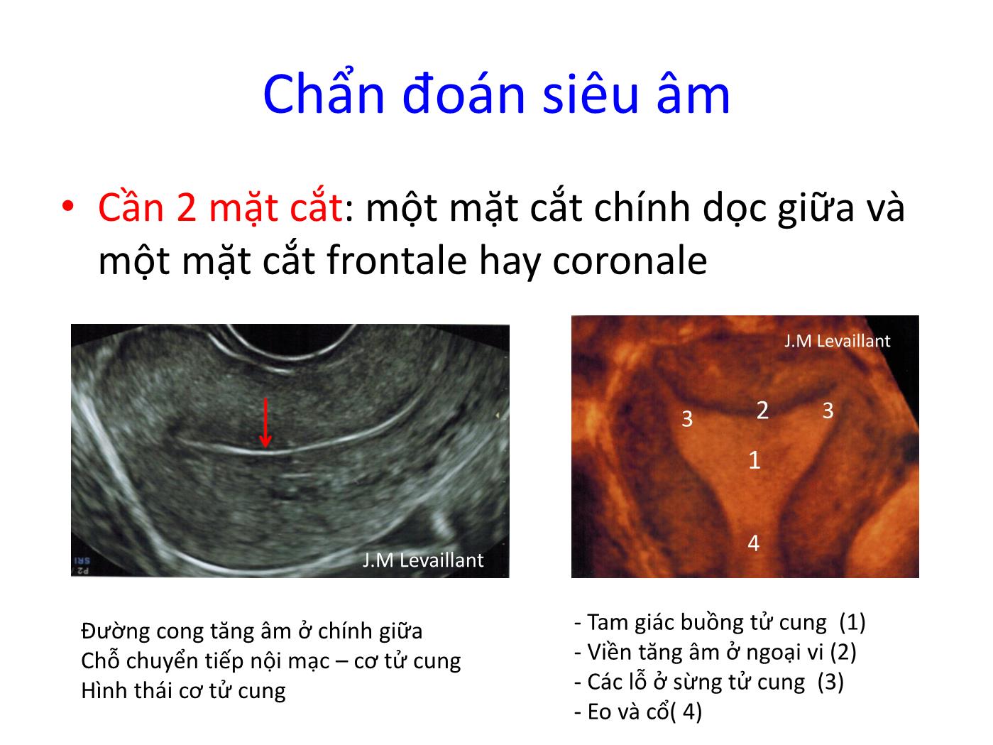 Bài giảng Bệnh lý cơ tử cung phần 2 trang 8