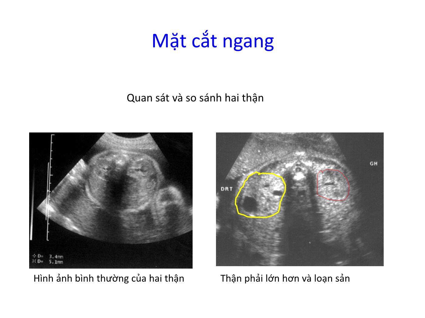 Bài giảng Hệ tiết niệu trang 10