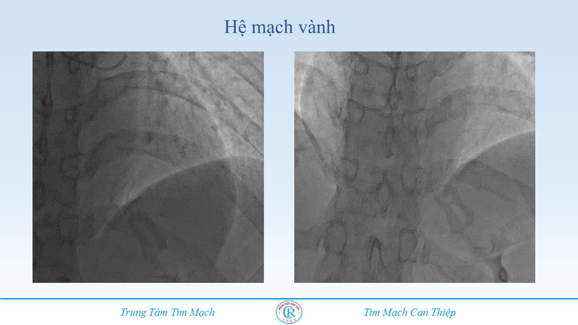 Đề tài Co thắt mạch vành : Chẩn đoán bị lãng quên - Nguyễn Việt Phương Thùy trang 5