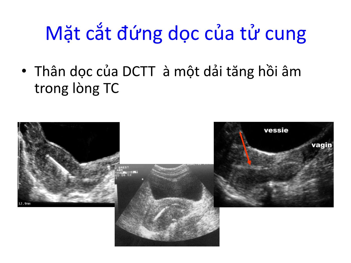 Bài giảng Siêu âm và đặt dụng cụ tránh thai trang 10