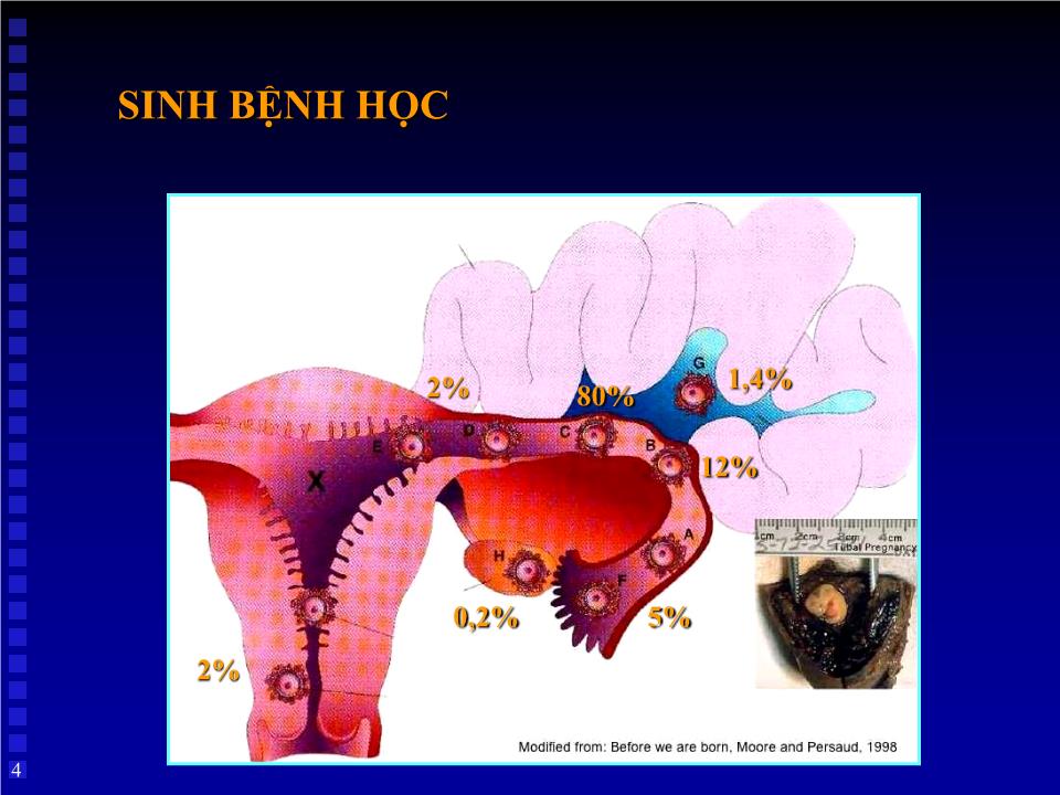 Bài giảng Thai ngoài tử cung - Huỳnh Văn Nhàn trang 4