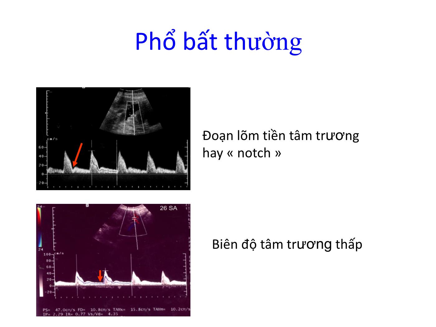 Đề tài Vai trò của siêu âm Doppler trong chẩn đoán và theo dõi thai chậm phát triển trong tử cung trang 6