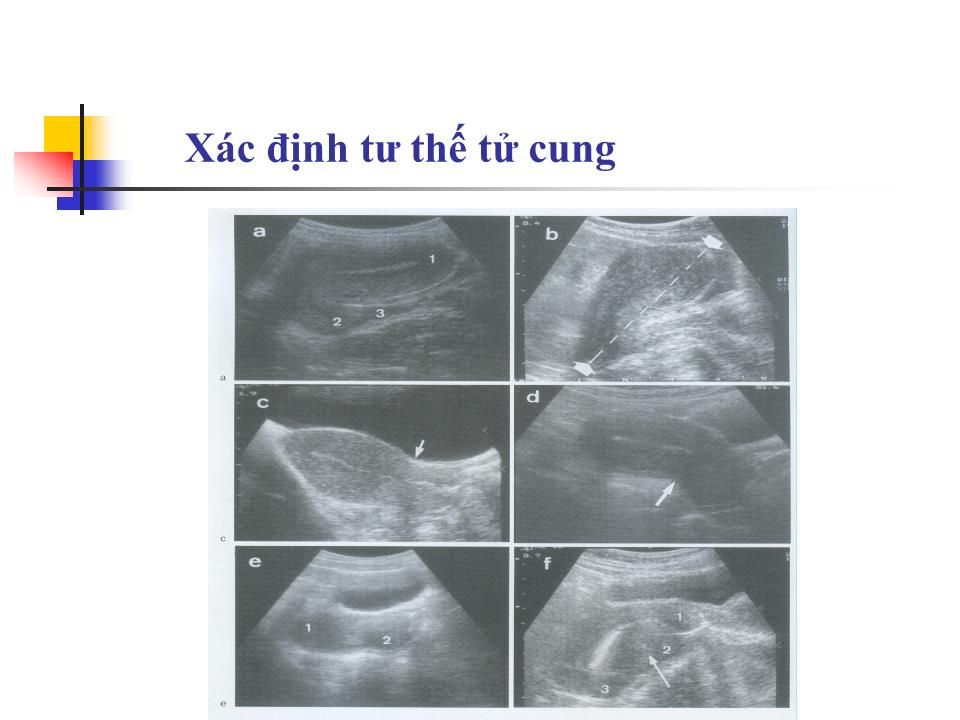 Bài giảng Kỹ thuật siêu âm phụ khoa - Nguyễn Anh Tuấn trang 7