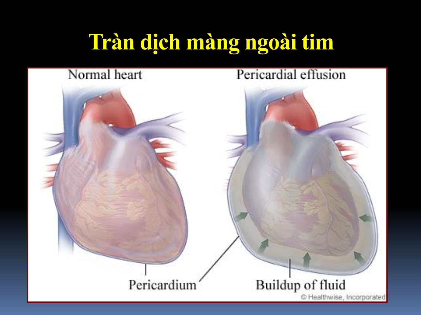 Bài giảng Cấp cứu tràn dịch màng tim gây ép tim - Hoàng Việt Anh trang 4