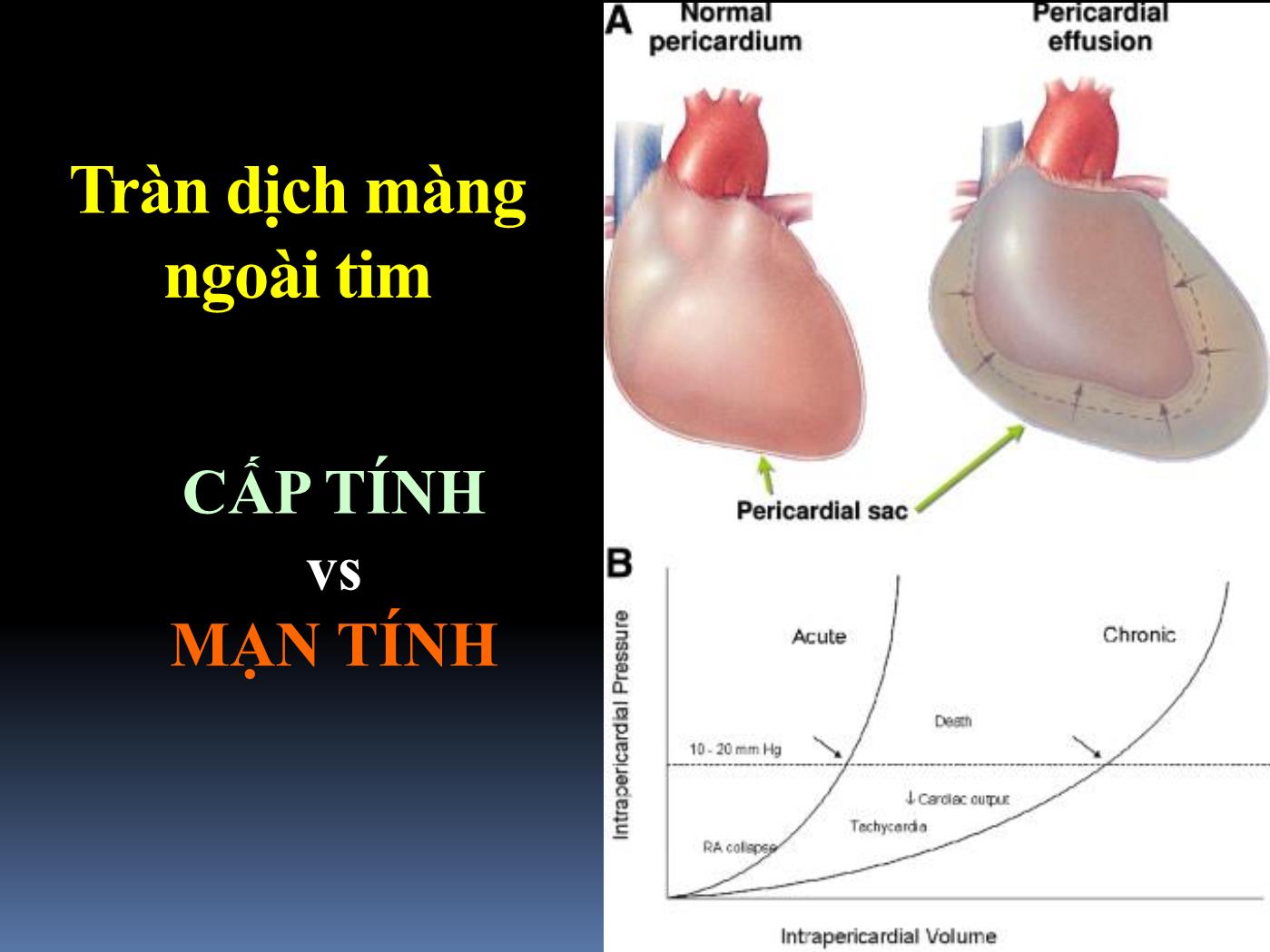 Bài giảng Cấp cứu tràn dịch màng tim gây ép tim - Hoàng Việt Anh trang 7