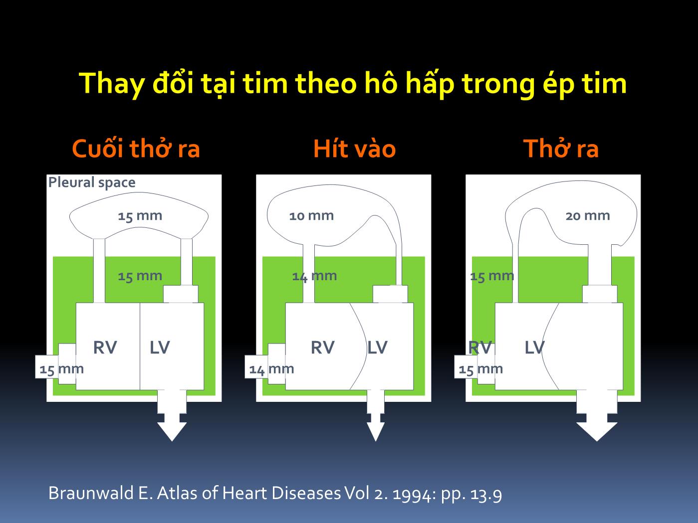 Bài giảng Cấp cứu tràn dịch màng tim gây ép tim - Hoàng Việt Anh trang 8