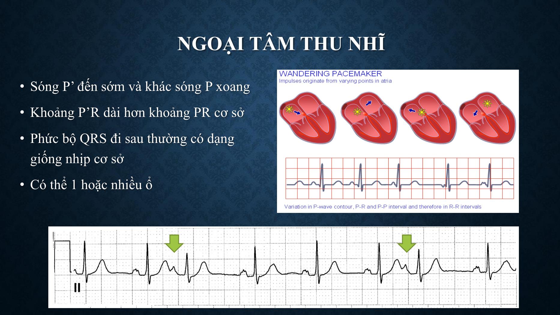 Bài giảng Chẩn đoán và xử trí ngoại tâm thu - Trần Tuấn Việt trang 4