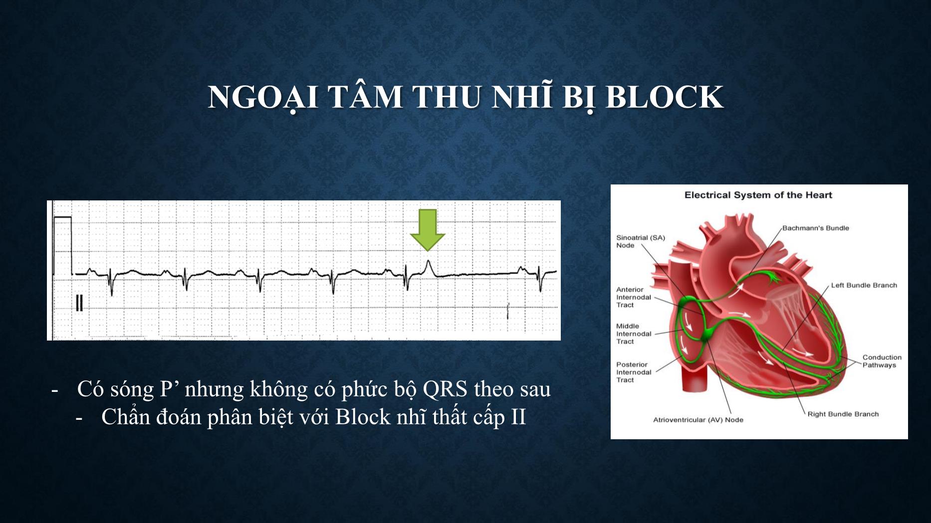 Bài giảng Chẩn đoán và xử trí ngoại tâm thu - Trần Tuấn Việt trang 5