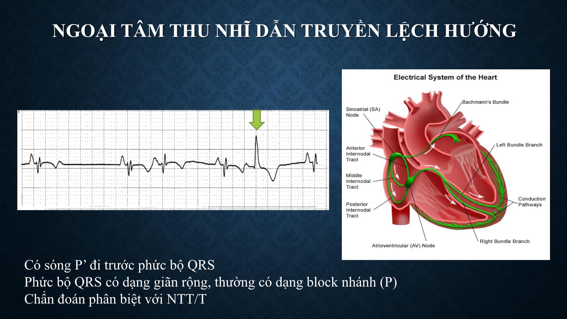 Bài giảng Chẩn đoán và xử trí ngoại tâm thu - Trần Tuấn Việt trang 6