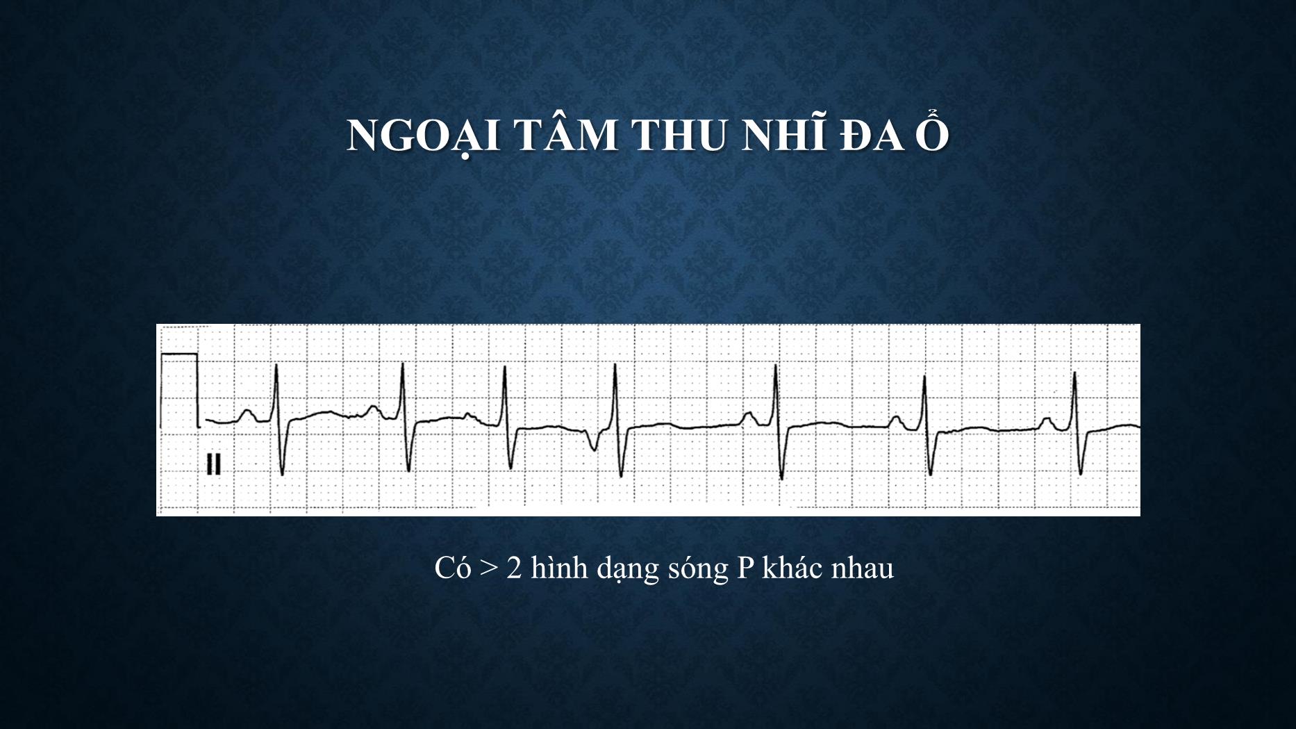 Bài giảng Chẩn đoán và xử trí ngoại tâm thu - Trần Tuấn Việt trang 7