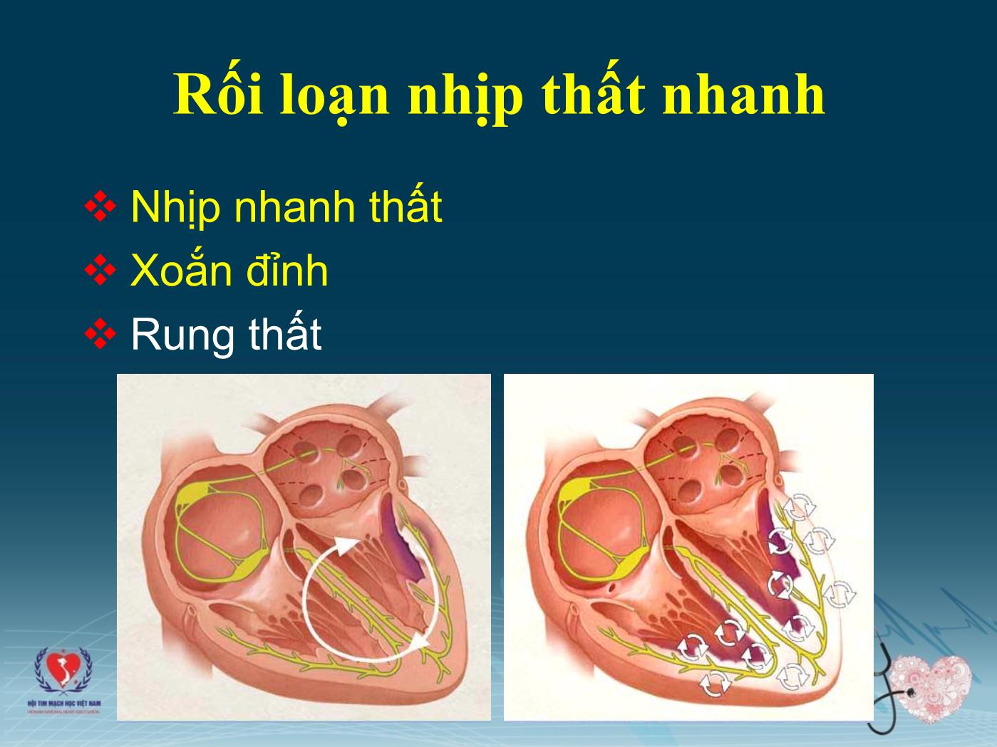 Chẩn đoán và xử trí các rối loạn nhịp cấp tính - Trần Văn Đồng trang 4