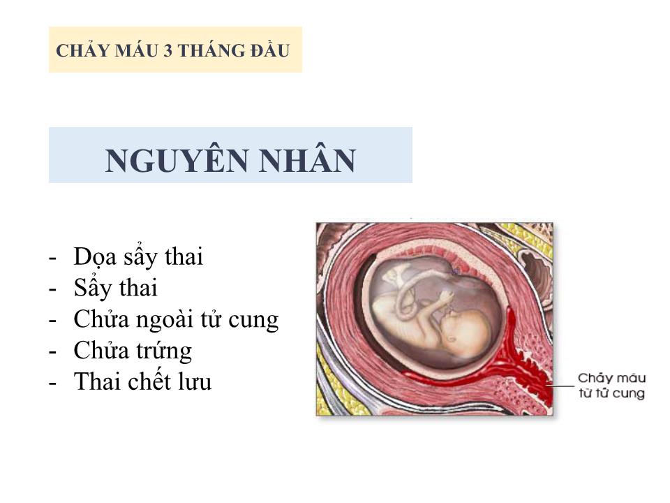 Bài giảng Chảy máu 3 tháng đầu thời kỳ thai nghén - Nguyễn Mạnh Thắng trang 4