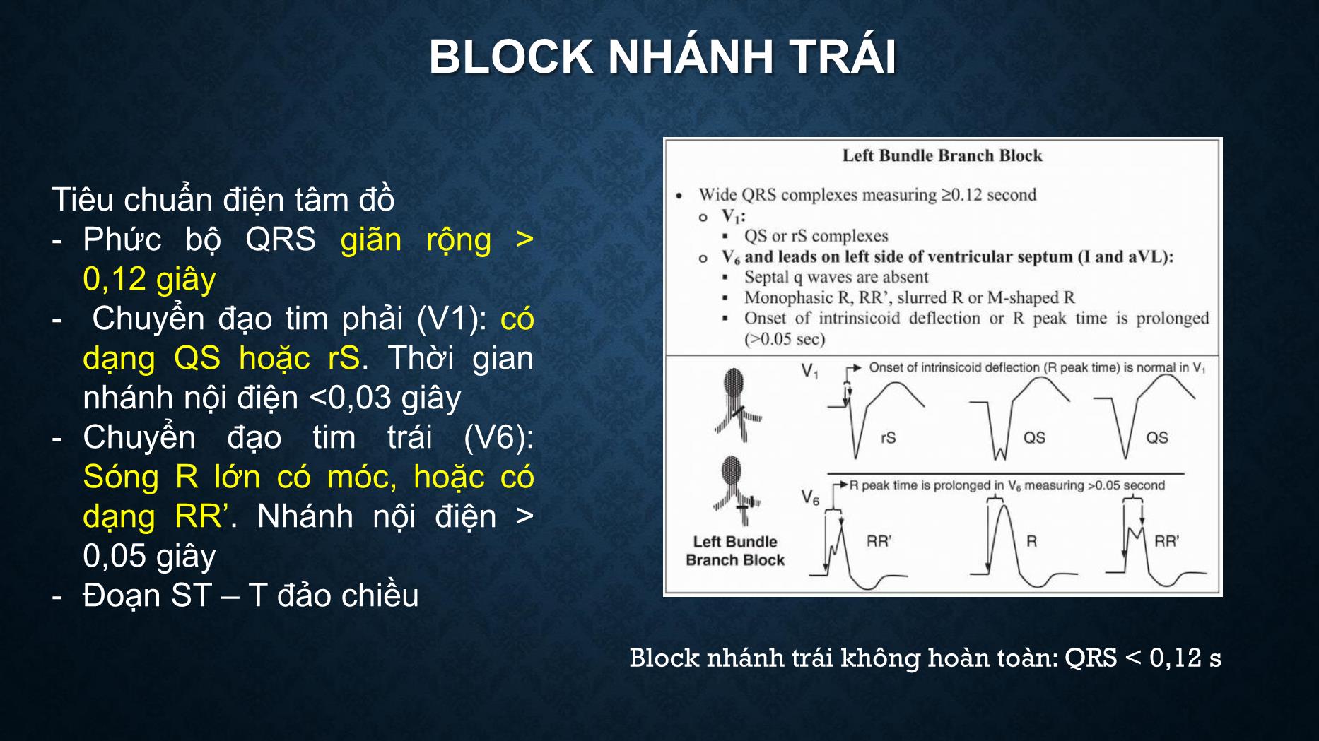 Bài giảng Điện tâm đồ trong rối loạn dẫn truyền tim - Trần Tuấn Việt trang 10